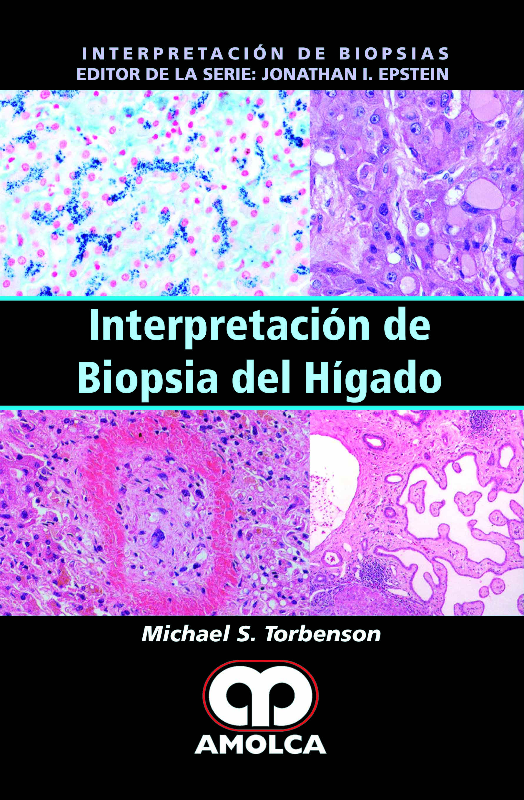 INTERPRETACIÓN DE BIOPSIA DEL HIGADO