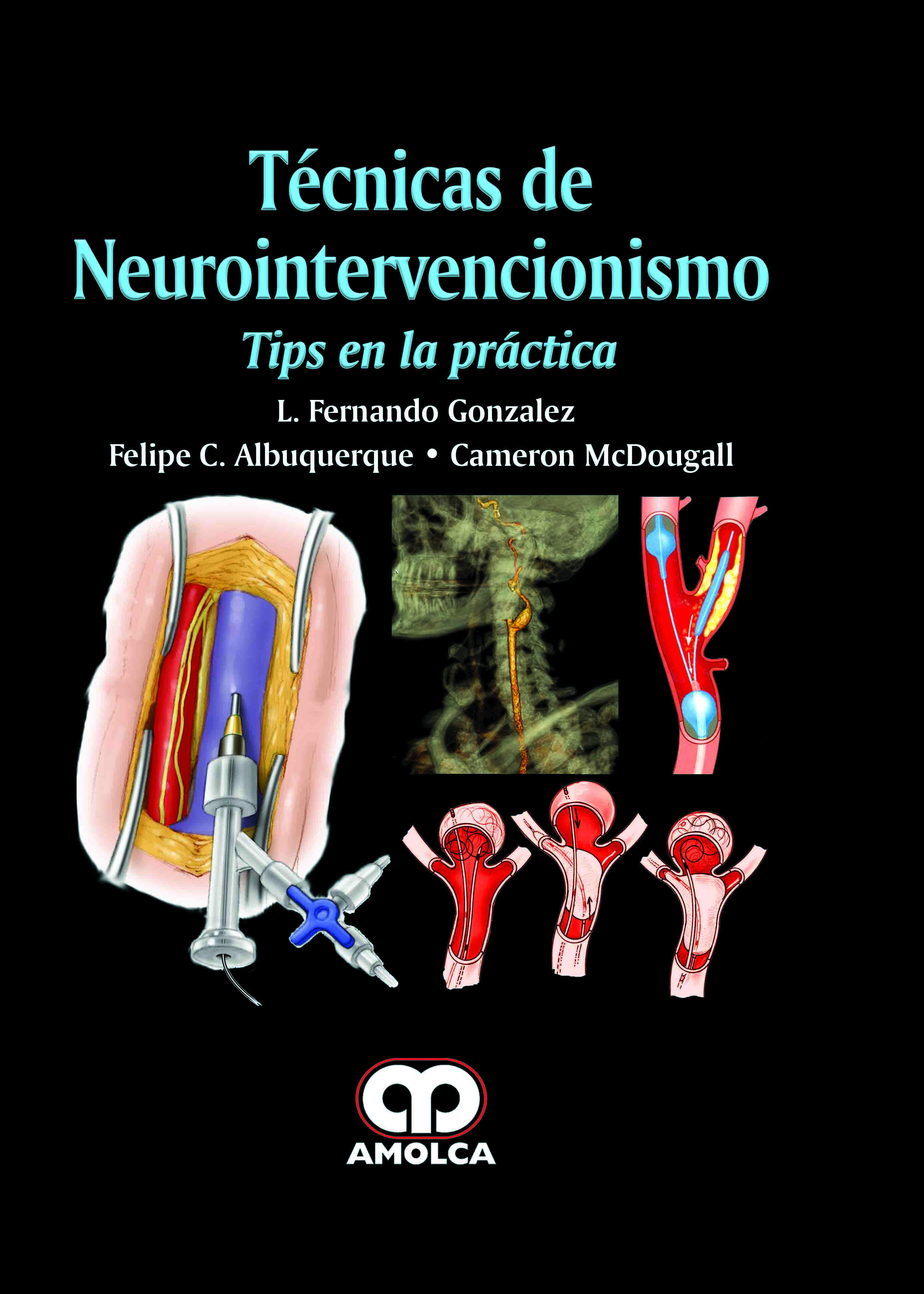 TÉCNICAS DE NEUROINTERVENCIONISMO. TIPS EN LA PRÁCTICA