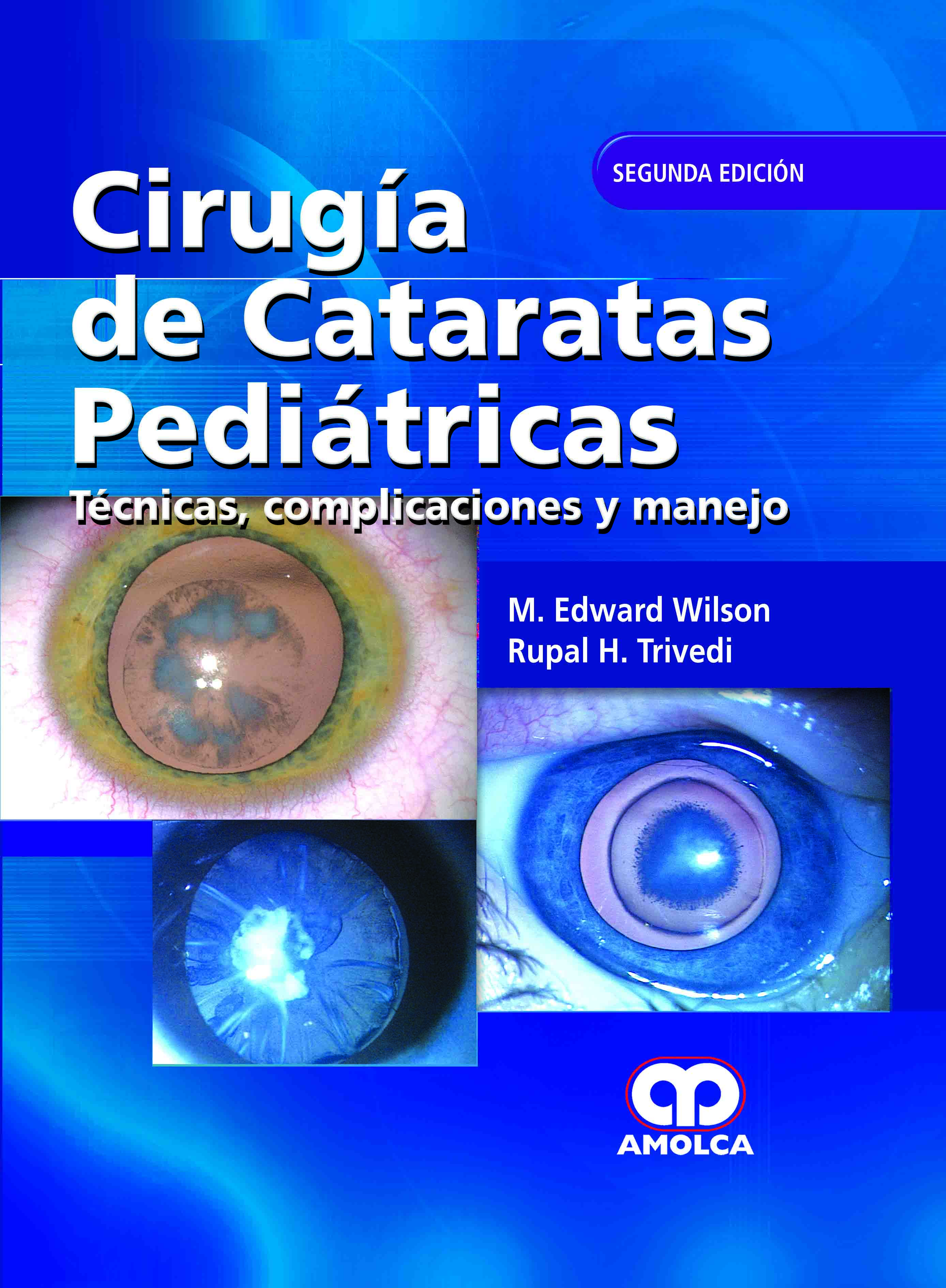 CIRUGÍA DE CATARATAS PEDIATRICAS