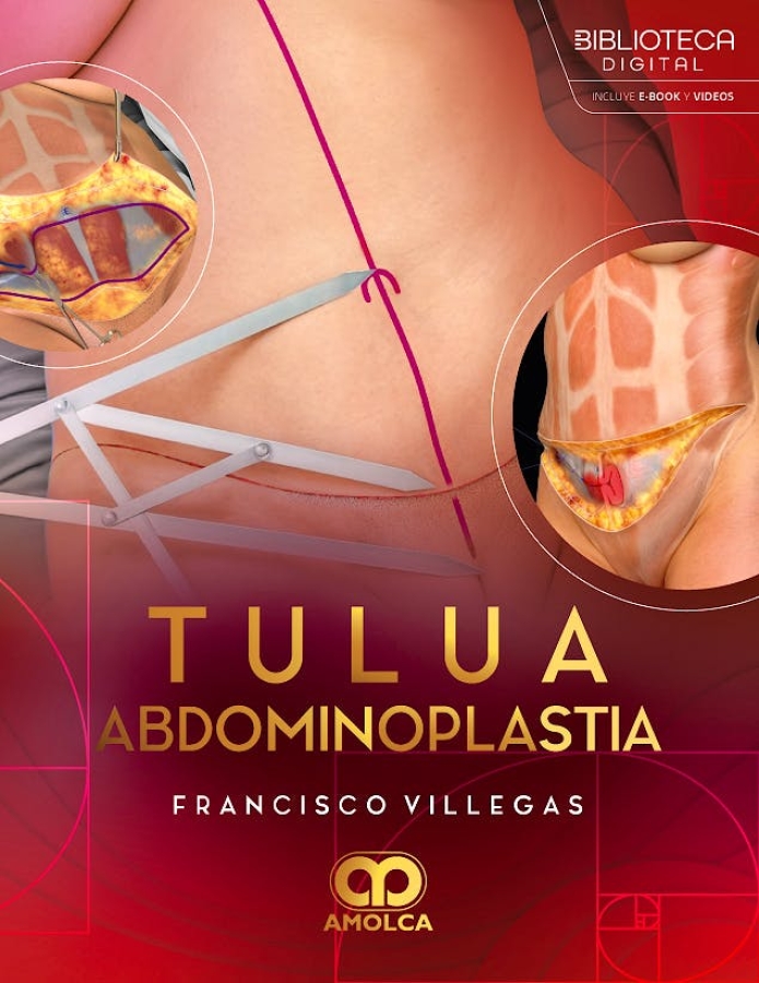 TULUA ABDOMINOPLASTIA