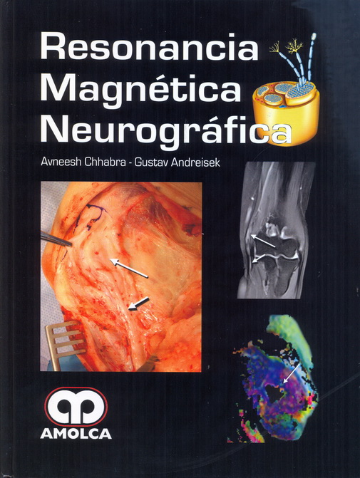 Resonancia Magnética Neurográfica