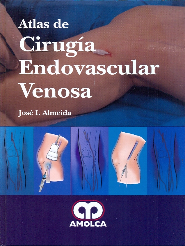 ATLAS DE CIRUGÍA ENDOVASCULAR VENOSA