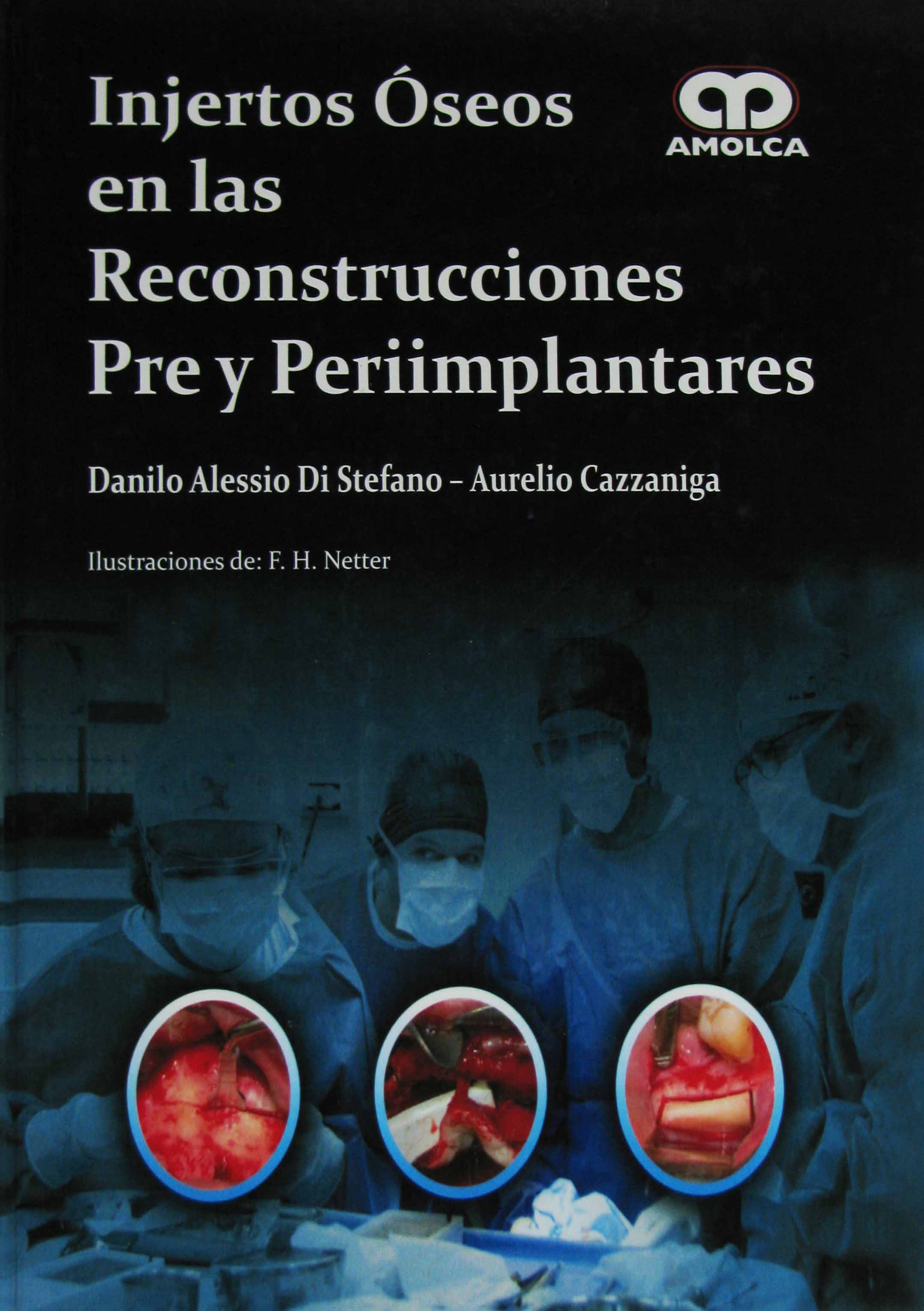 INJERTOS OSEOS EN LAS RECONSTRUCCIONES PRE Y PERIIMPLANTARES