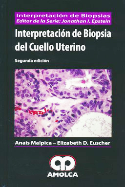 INTERPRETACION DE BIOPSIA DEL CUELLO UTERINO