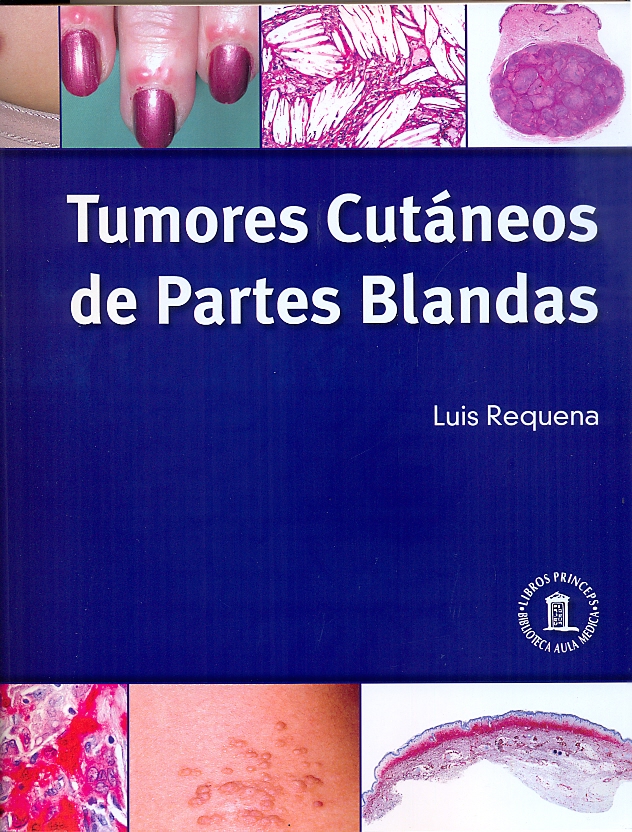 TUMORES CUTÁNEOS DE PARTES BLANDAS