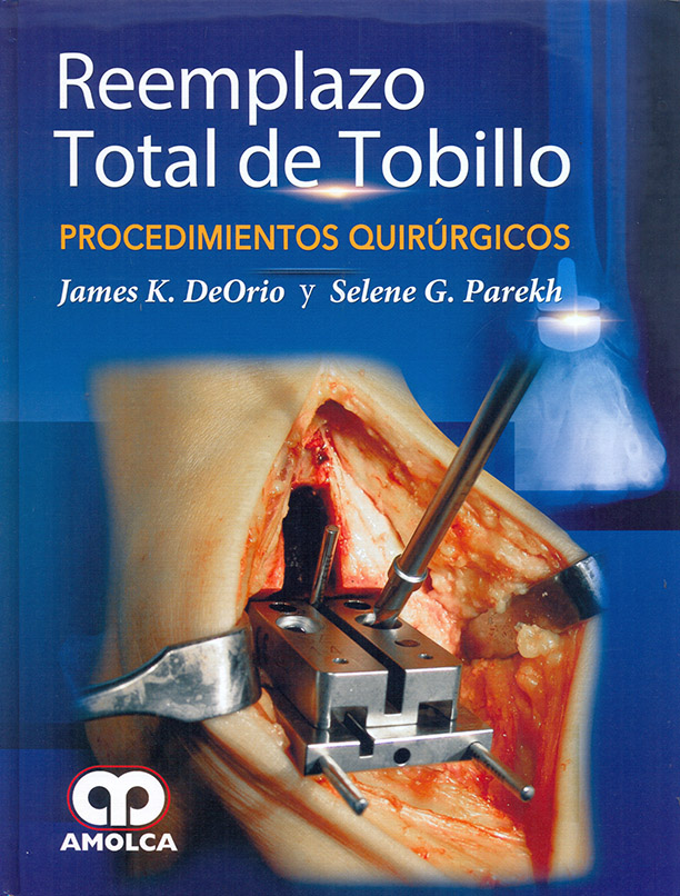 Reemplazo Total de Tobillo – Procedimientos Quirúrgicos