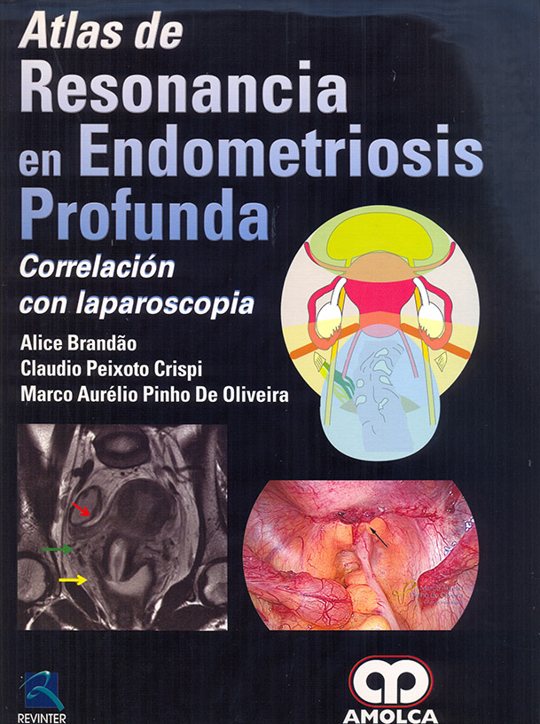 Atlas de Resonancia en Endometriosis Profunda Correlación con laparoscopia