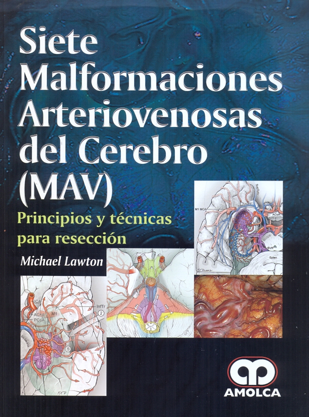 SIETE MALFORMACIONES ARTERIOVENOSAS DEL CEREBRO