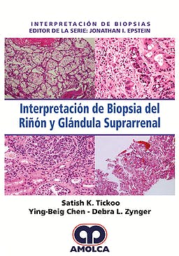 Interpretación de Biopsia del Riñón y Glándula Suprarrenal (Interpretación de Biopsias)